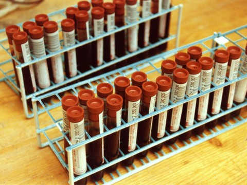 Il développe une hépatite aiguë à cause des boissons énergétiques