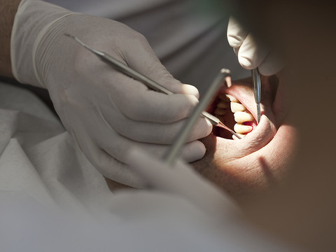 Zurich: des mutations génétiques favorisent les caries