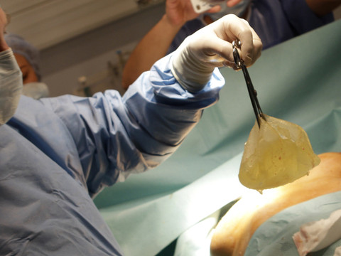Prise en charge d'implants mammaires refusée à une transsexuelle
