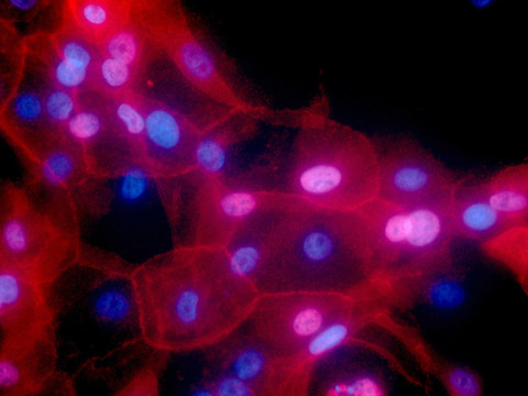 Deux tiers des mutations responsables du cancer dues à la malchance