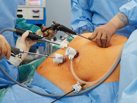La chirurgie de l'obésité favorise la fin du célibat et le divorce