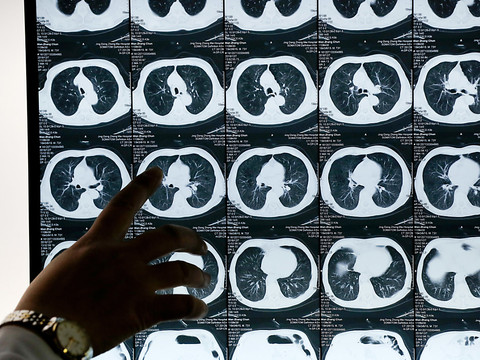 Cancer: 1,4 million de décès prévus en 2019 dans l'UE (étude)