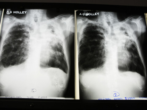 Il est possible d'éradiquer la tuberculose en 25 ans