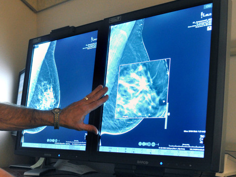 Cancer du sein: un nouveau traitement augmente le taux de survie