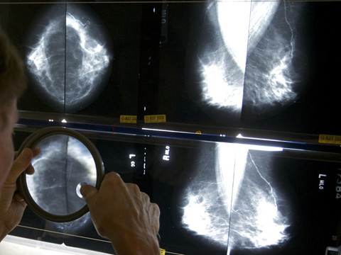 Lien statistique entre cancer du sein et traitement de la ménopause