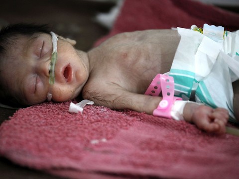 Un jeune enfant sur trois est mal nourri ou en surpoids (UNICEF)