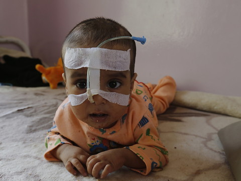Des extrêmes de malnutrition dans de nombreux pays