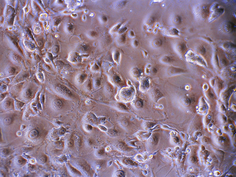 Un bébé traité par cellules souches pour une maladie du foie