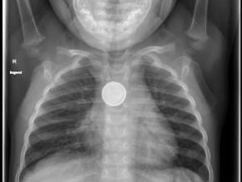 Mise en garde des pédiatres contre les piles bouton