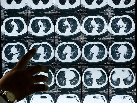 Novartis essuie un nouvel échec clinique avec le canakinumab