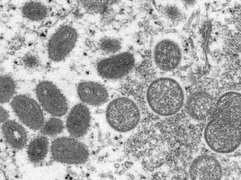 Deuxième cas suisse de variole du singe confirmé à Genève