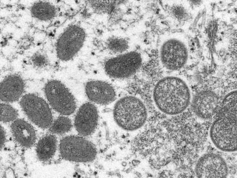 95% cas de variole du singe transmis lors de relations sexuelles