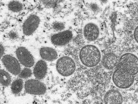 Variole du singe: premier décès hors d'Afrique