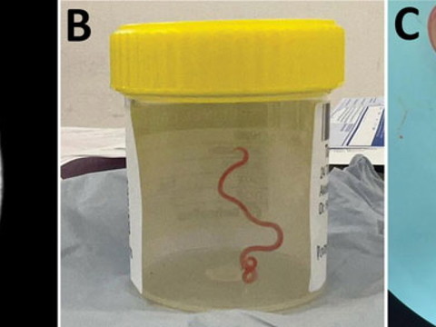 Un ver qui parasite les serpents dans le cerveau d'une Australienne