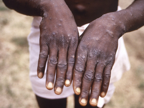 Mpox: le variant létal découvert en Suède, première hors d'Afrique