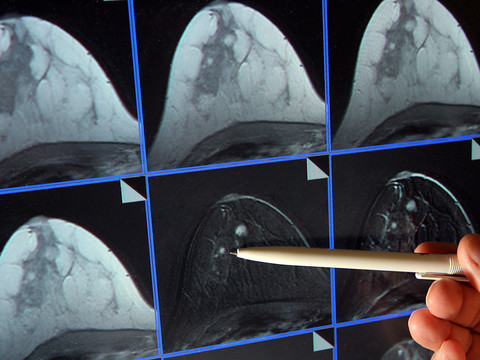 Roche s'offre des inhibiteurs de CDK pour 850 millions de dollars