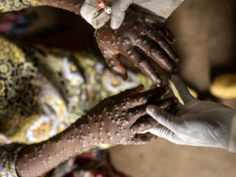 Mpox: un premier cas du nouveau variant confirmé en Allemagne
