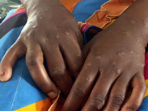 Plus de 1100 cas de mpox recensés et 9 décès en Sierra Leone