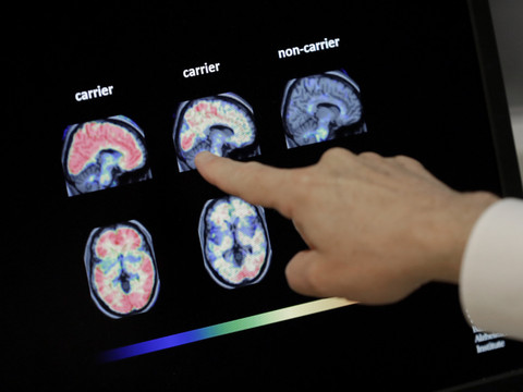 Alzheimer: premier test sanguin de dépistage validé aux Etats-Unis