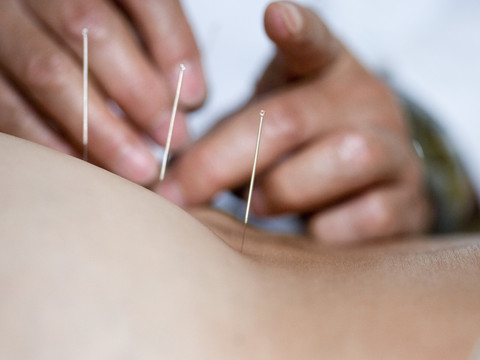 Acupuncture et homéopathie continueront d'être remboursées