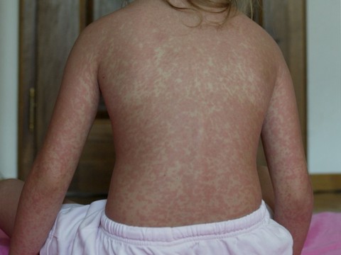USA: l'épidémie de rougeole atteint un niveau jamais vu en 35 ans