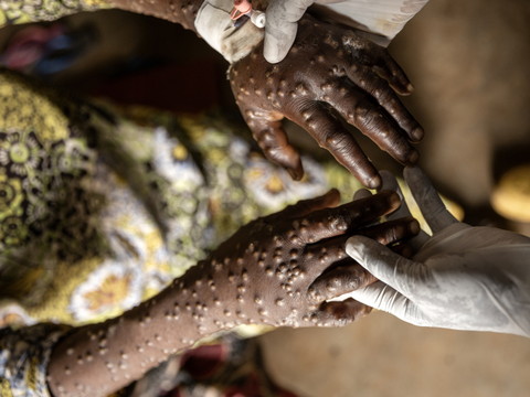 Mpox: de nombreux cas en RDC seraient de faux diagnostics (UNIGE)