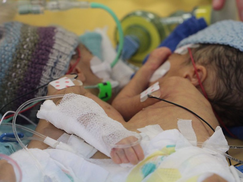 Bébés siamois de 8 jours séparés avec succès à Berne