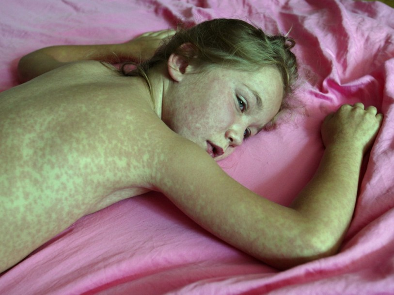 Les cas de rougeole ont doublé en une année en Suisse