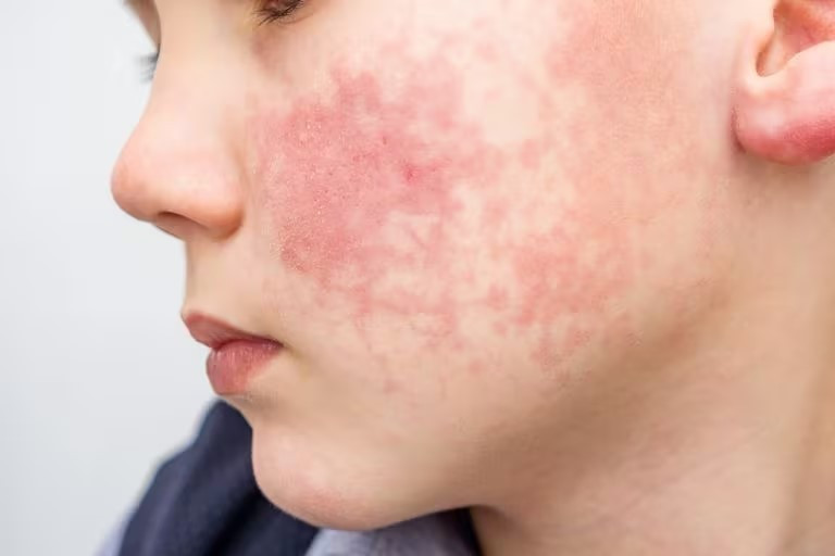 Le parvovirus B19 également appelée « cinquième maladie » peut provoquer des éruptions cutanées sur les joues des enfants. Source libre de droit 