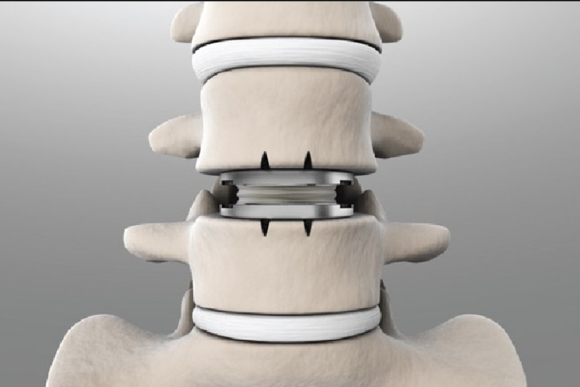 Une prothèse discale immature a été posé sur sept patients. (Photo : Spinal Kinetics)