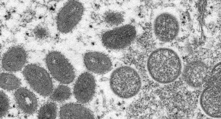 Premier cas de variole du singe en Italie